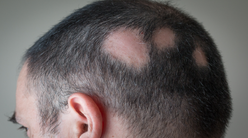 دواء جديد يعيد 80٪ من الشعر لمرضى الثعلبة